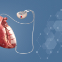 Na KCUS prvi slučaj ugradnje uređaja za mikrostrujnu terapiju srca